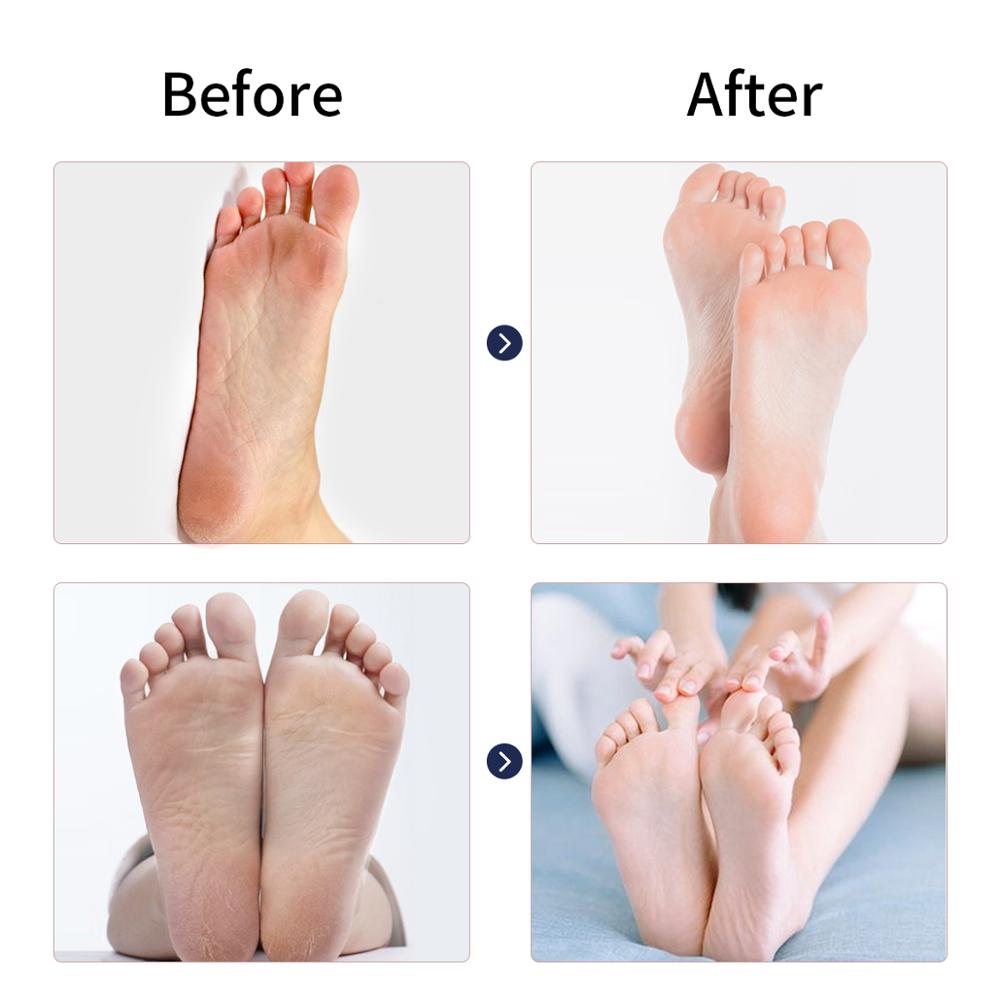 electric-feet-callus-remover