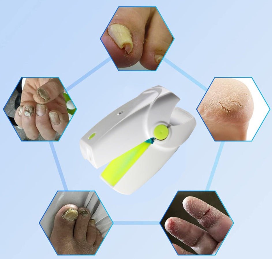 portable-fungus-nail-laser