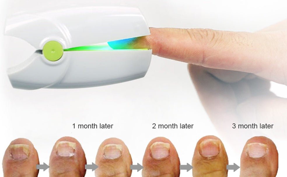 portable-fungus-nail-laser